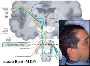 Bilateral Root-MEPs.jpg