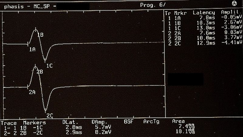 File:Bruxer Jaw jerk.jpeg