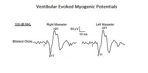 Figure 1: Vestibula Evoked Myogenic Potentials (see chapter 'Complex Systems'