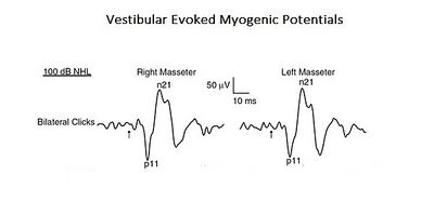Figure 1: Vestibula Evoked Myogenic Potentials (see chapter 'Complex Systems'