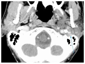 Pleomorphic adenoma 3.jpeg