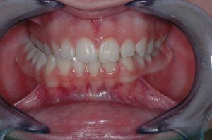 Occlusion in young lady, needing attention.jpg