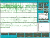 EMG Propofol.jpeg