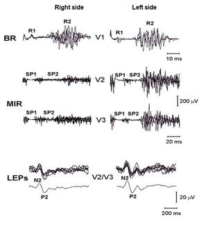 Laser Evoked Potentials - Blink reflex - Masseter Silent Period.jpg