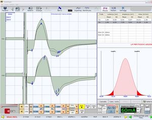 TCS - Motor Evoked Potentials of trigeminal roots in open bite patient.jpg