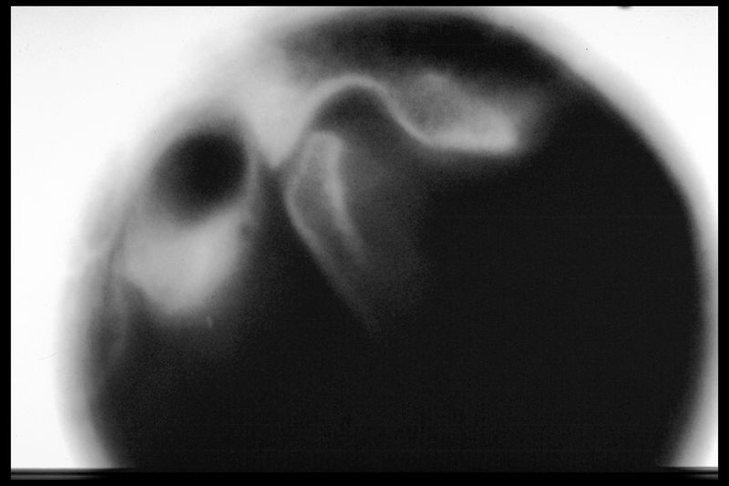 File:Politomography TMJ.jpg